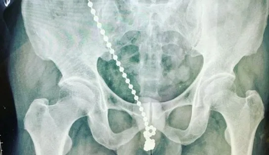 Após ter introduzido corrente de metal na uretra, homem tem pênis operado; ele alega sentir “choques elétricos”