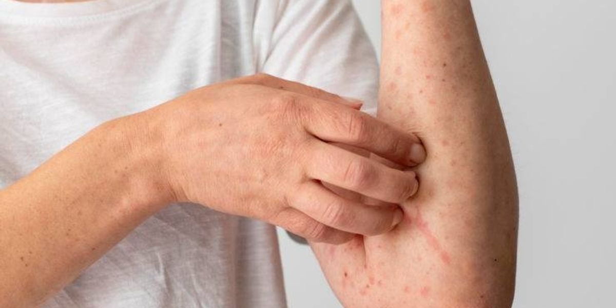 Vigil&acirc;ncia Epidemiol&oacute;gica emite alerta sobre casos de catapora na Bahia; saiba mais