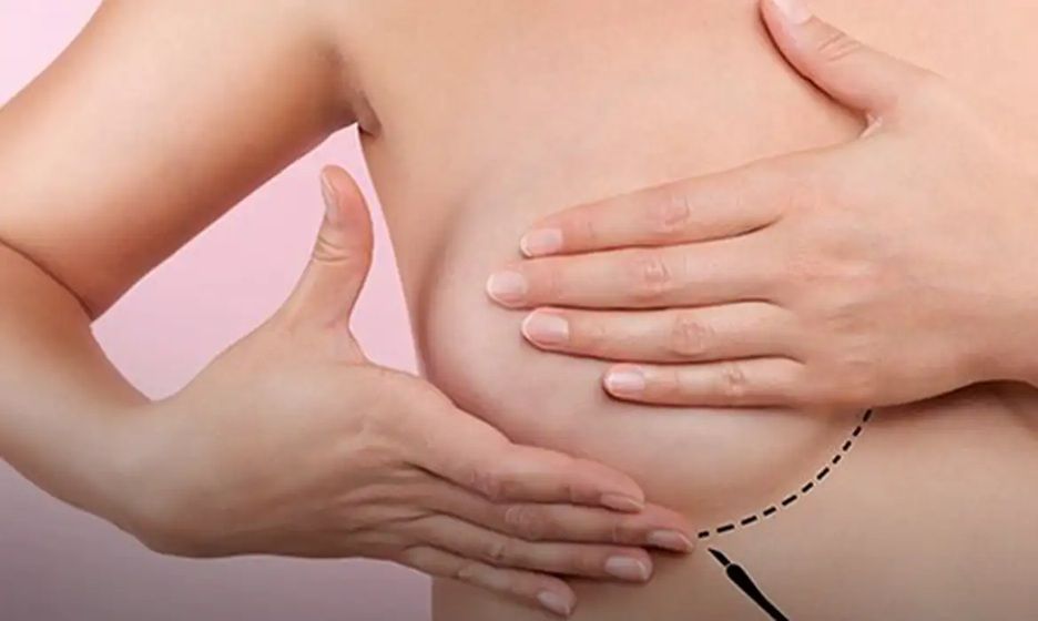 Implantes De Silicone   Divulgação   Sociedade Brasileira De Mastologia