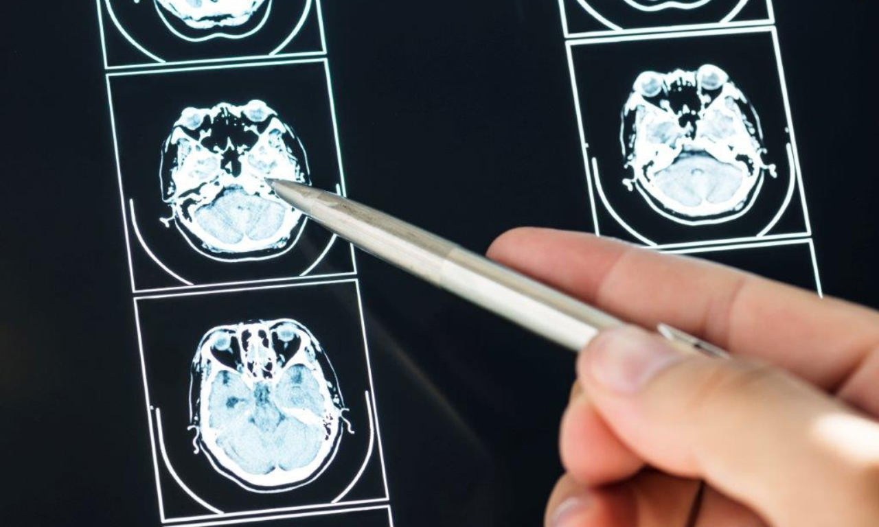 Tumor Cerebral. Foto: Freepik
