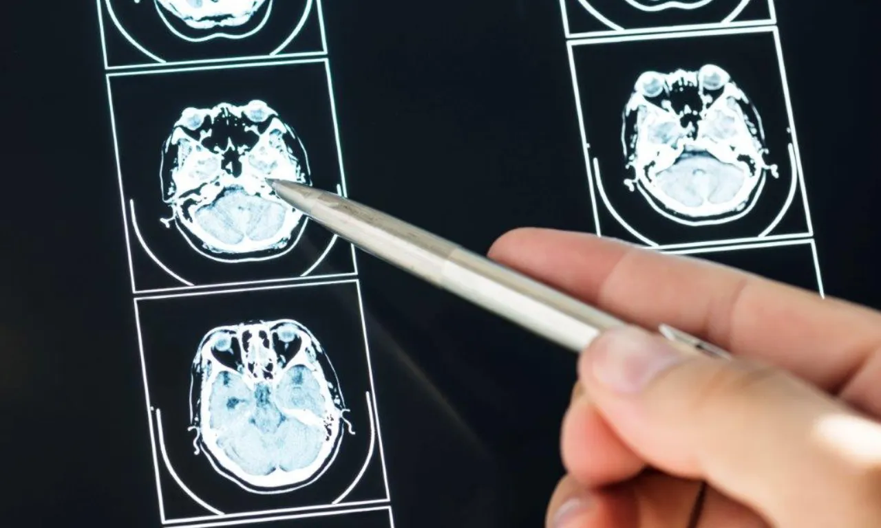 Tumor Cerebral