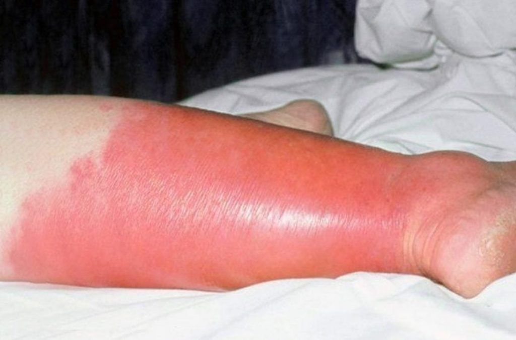 Erisipela. Foto: MD Sa&uacute;de. 
