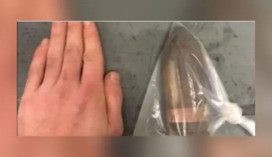 Bumbum granada! Homem introduz projétil de canhão no reto e hospital tem que acionar equipe antibomba para retirar 