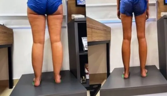 Yasmin Brunet exibe corpo após tratamento para lipedema