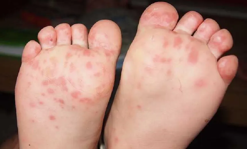 Município de Nazaré registra 16 casos de crianças com doença altamente contagiosa
