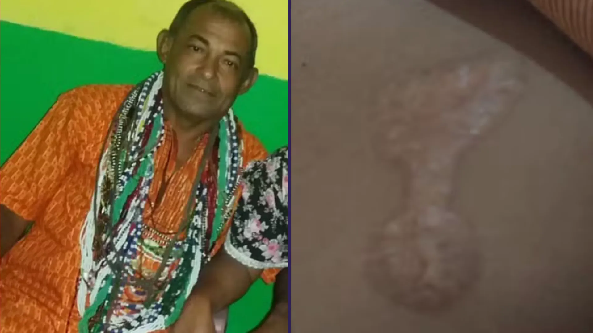Pai de santo é acusado de queimar fiéis com ferro quente e charutos na Bahia