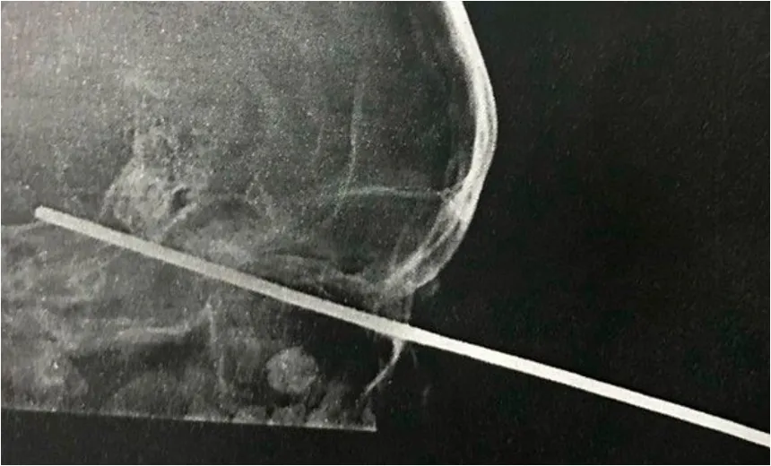 Ironia: criança de 8 anos fica com espeto cravado no olho em Santa Luzia