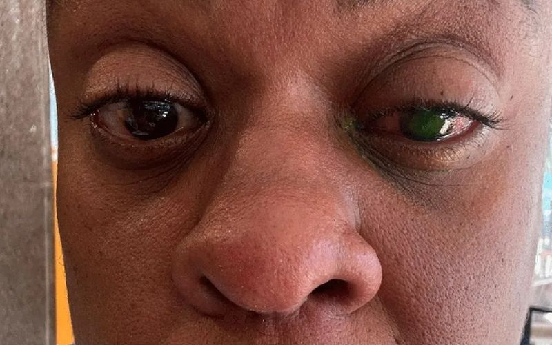 Al&eacute;m da sensibilidade &agrave; luz, a atriz tamb&eacute;m enfrenta restri&ccedil;&otilde;es no uso de maquiagem e exposi&ccedil;&atilde;o prolongada a telas, o que pode atrasar sua recupera&ccedil;&atilde;o completa/Foto: Redes Sociais