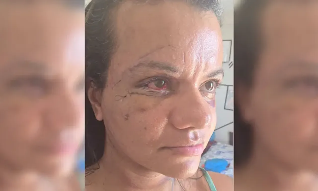 Mulher agredida com mais de 60 socos mostra rosto ap&oacute;s cirurgia facial.Foto: Reprodu&ccedil;&atilde;o