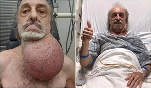 Idoso de 81 anos retira tumor de três quilos do pescoço