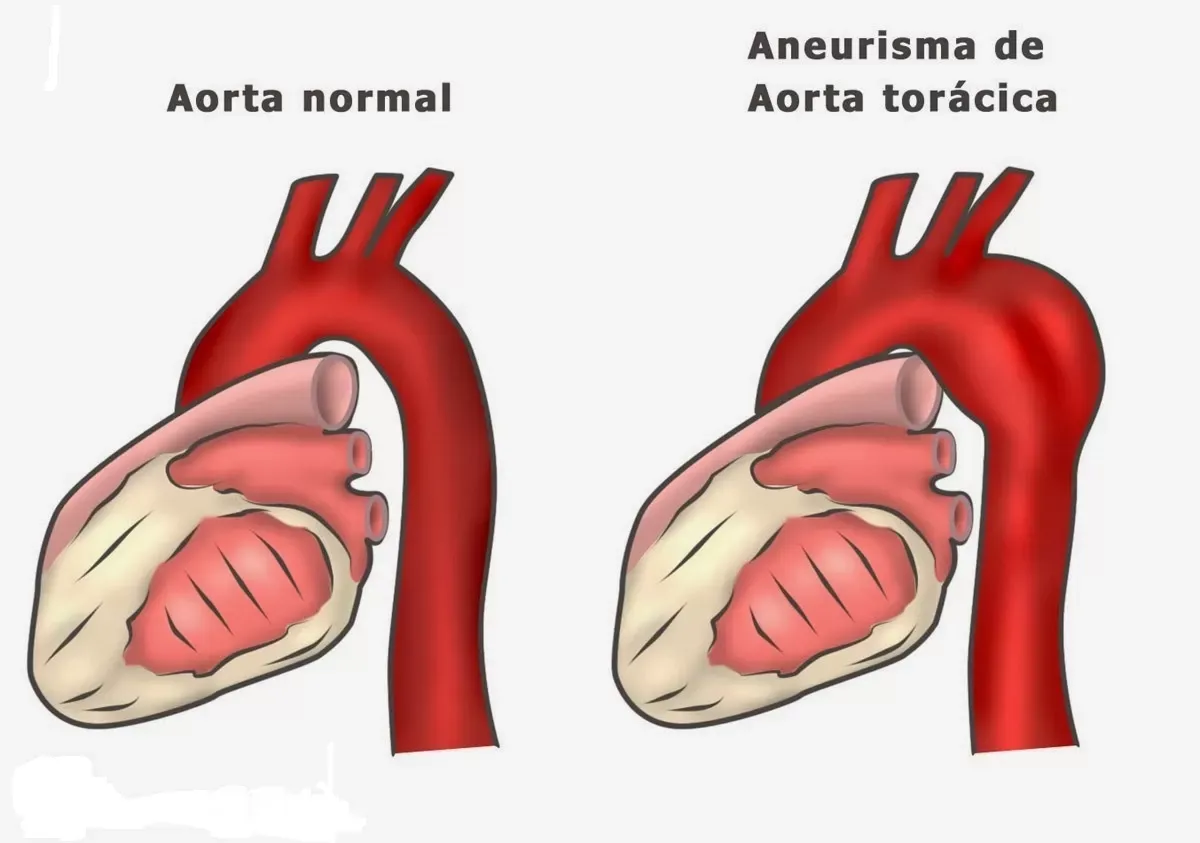 Aneurisma de aorta. Foto: Ilustração