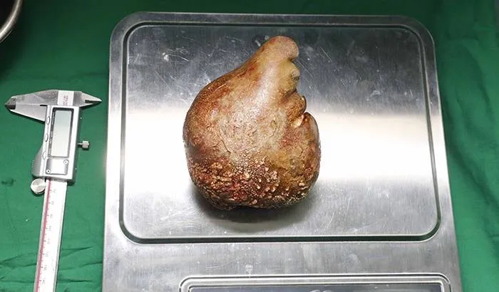 Espantoso! Maior 'pedra nos rins' encontrada no mundo tem 800g