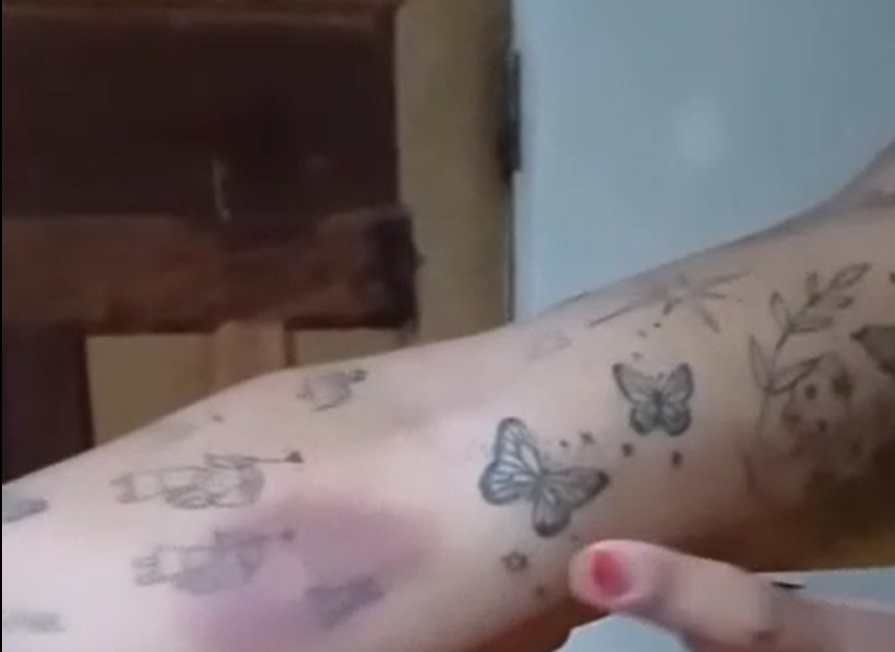 Hematoma provocado pela agress&atilde;o