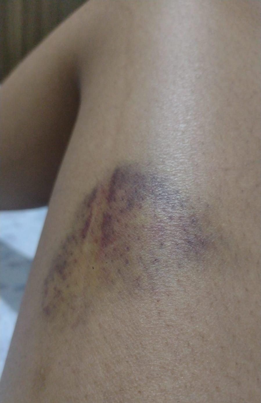 Hematoma de Hyanny Cruz após pisar acidentalmente no vão entre o metrô e a plataforma. Foto: Acervo pessoal
