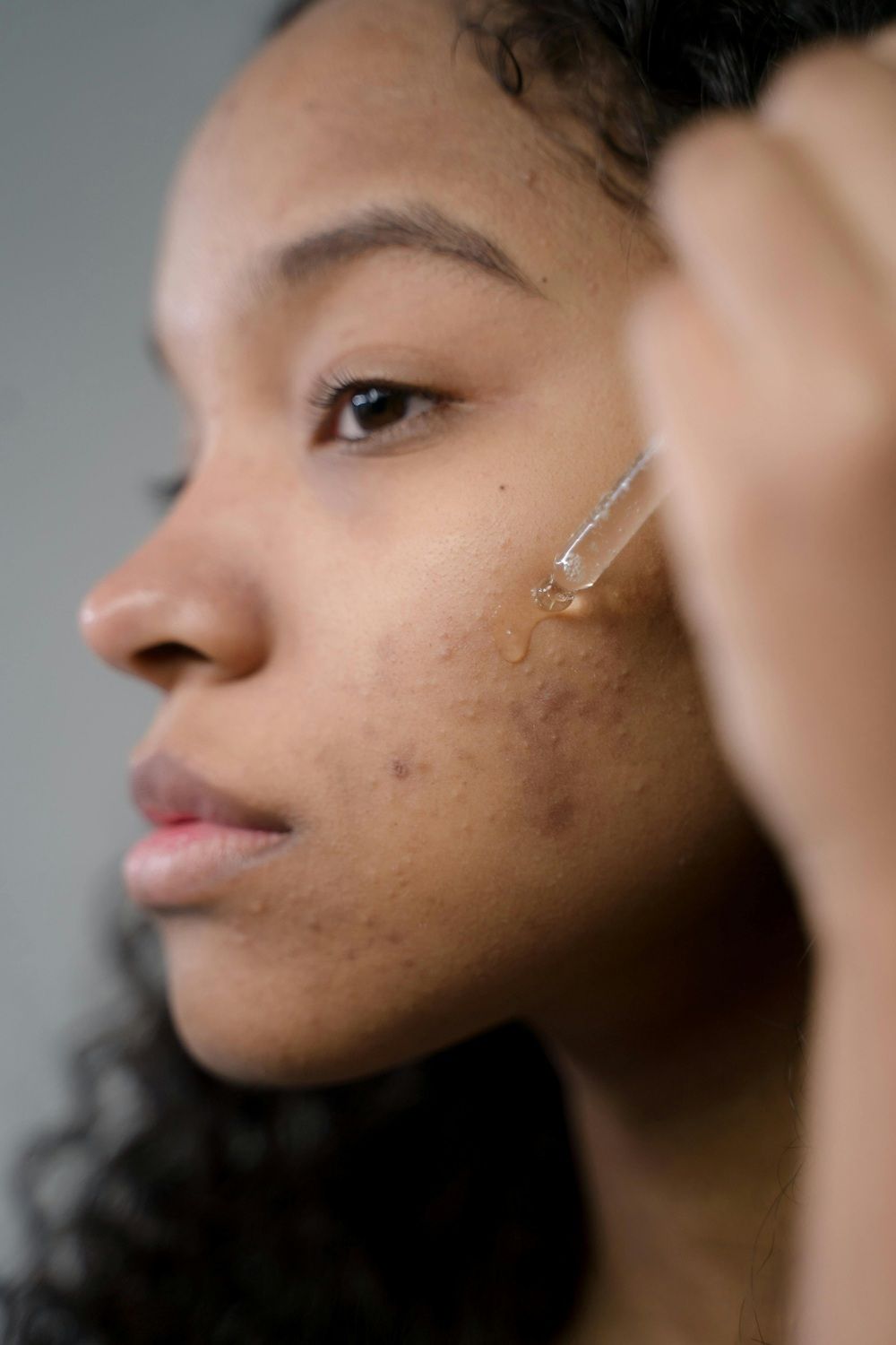 A adoção de uma rotina simples e regular de cuidados com a pele contribui para o controle da acne leve. | Foto: Ilustrativa/Pexels