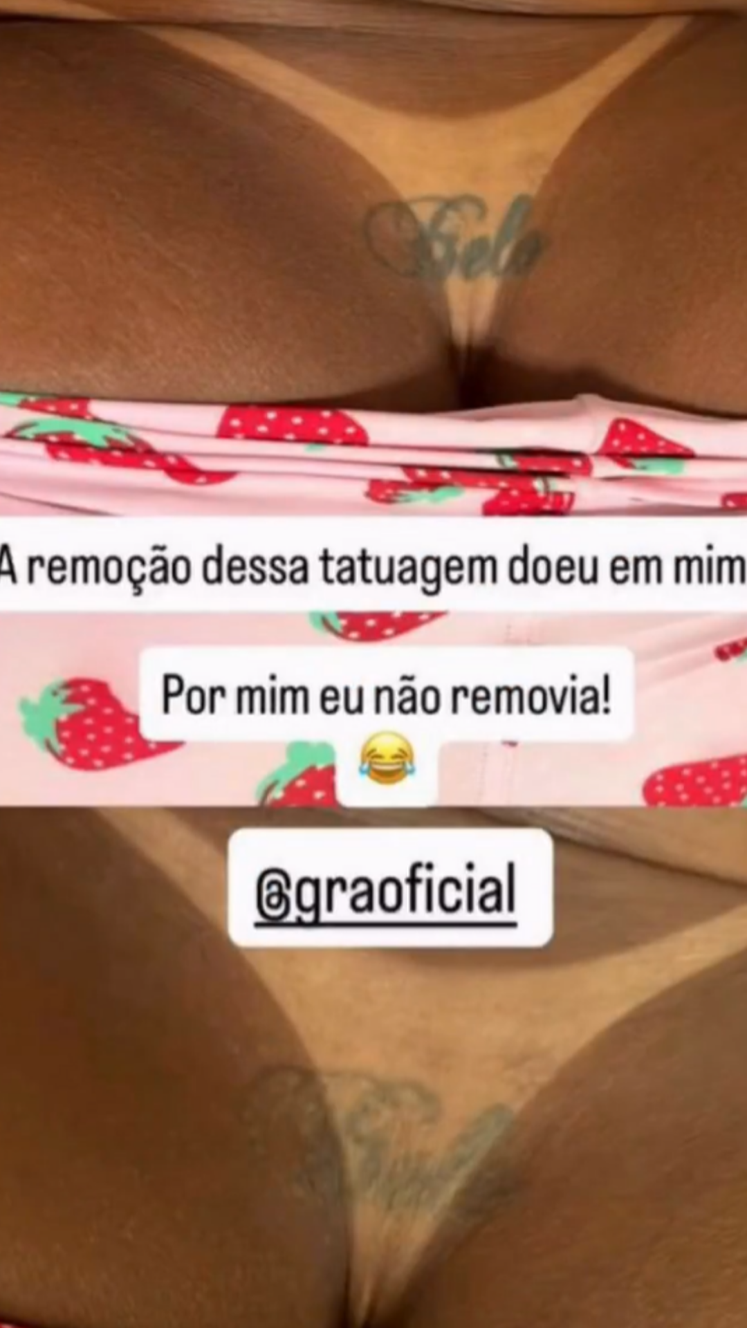 Antes e depois da remo&ccedil;&atilde;o da tatuagem com o nome de Belo do corpo de Gracyanne