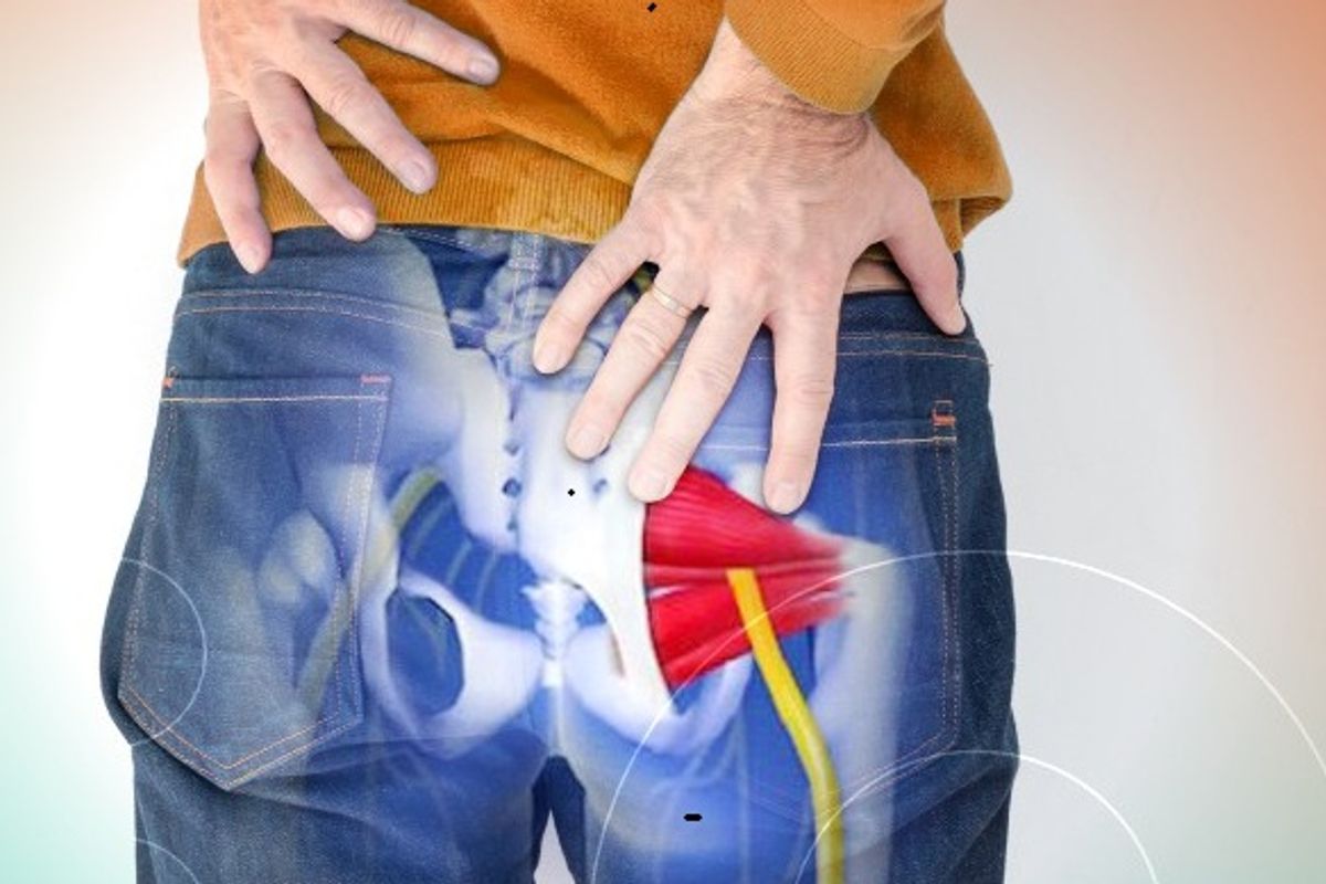 Sindrome do Piriforme. Foto: Ilustra&ccedil;&atilde;o