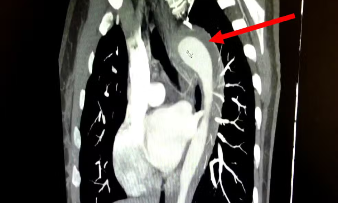 Mulher rompe aorta após orgasmo e é submetida a cirurgia de urgência.Foto: American Journal of Case Reports