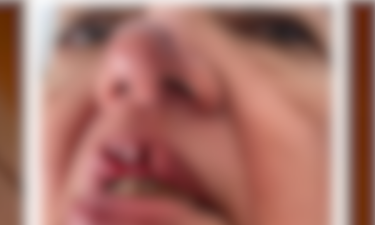 Mordida Pitbull. Foto: Reprodução