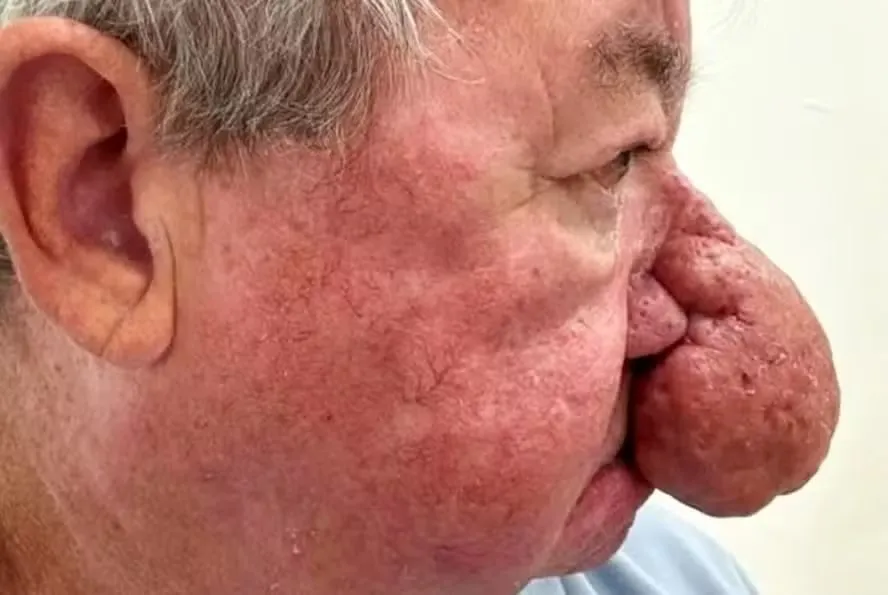Homem passa por cirurgia após crescimento do nariz: 'Não conseguia beijar'
