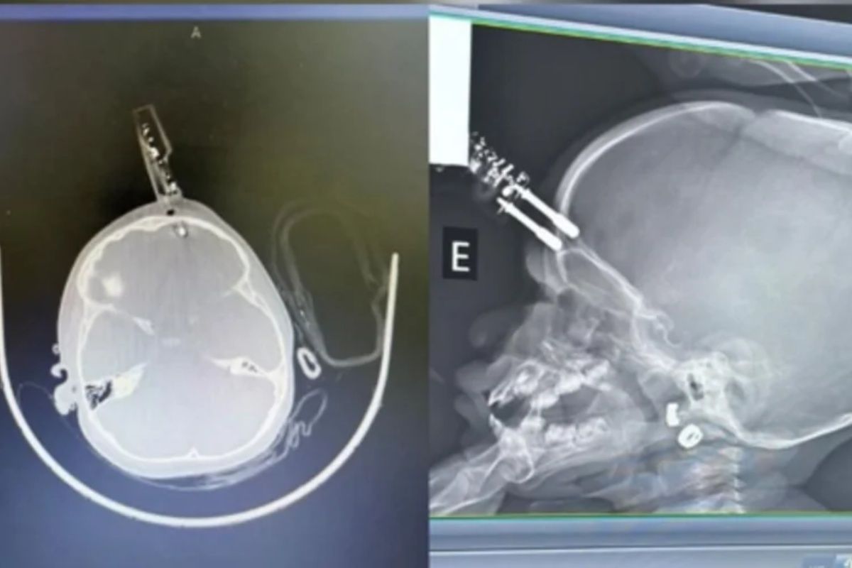 Beb&ecirc; fica com carregador de celular preso na testa ap&oacute;s cair de cama. Foto: Reprodu&ccedil;&atilde;o
