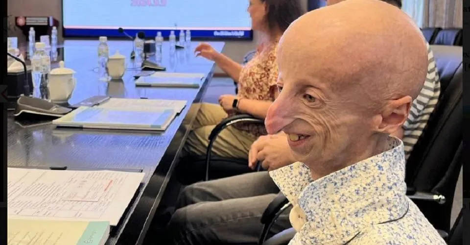 Morre aos 28 anos Sammy Basso, o 'Benjamin Button da vida real'