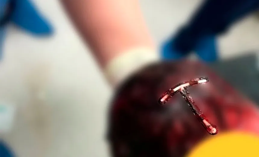 "Use para controle de natalidade, eles disseram", diz mãe após bebê nascer com DIU no cabelo