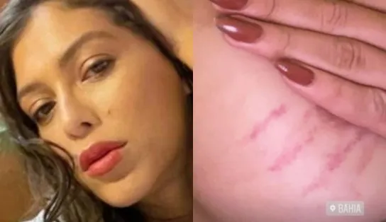Atriz transexual é agredida em viagem a Bahia e faz vídeo mostrando hematomas: “Transfobia”