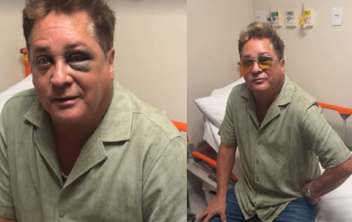 Cantor Leonardo tem olho roxo ap&oacute;s acidente. Foto: Reprodu&ccedil;&atilde;o | Instagram/@poliana